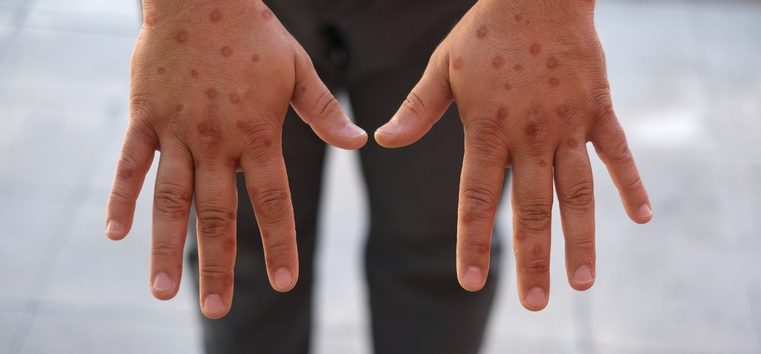 Estados Unidos confirmam primeiro caso de nova variante da mpox