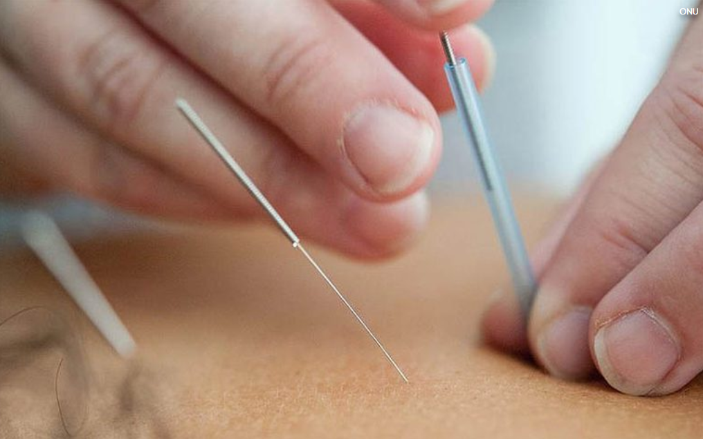 Brasil regulamenta a profissão de acupuntura